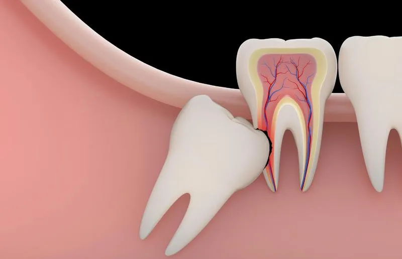 11 tuổi mọc răng khôn có sao không? Cách giúp trẻ giảm đau nhức răng khôn