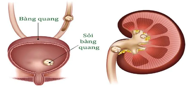 6 cách chữa sỏi bàng quang dân gian tại nhà hiệu quả