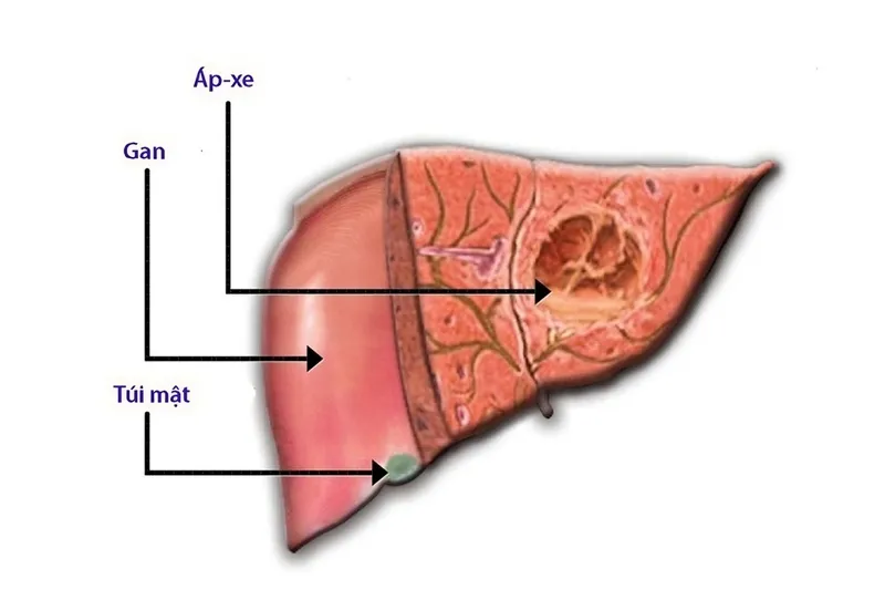 Áp xe đường gan mật - Nhận biết thế nào? Chữa trị ra sao?