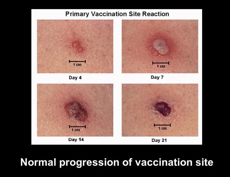 BCG vaccine là gì? Chi phí tiêm chủng như thế nào?