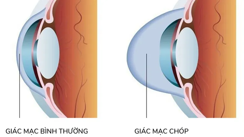 Bệnh giác mạc hình chóp có nguy hiểm không? Những điều bạn cần biết để bảo vệ thị lực