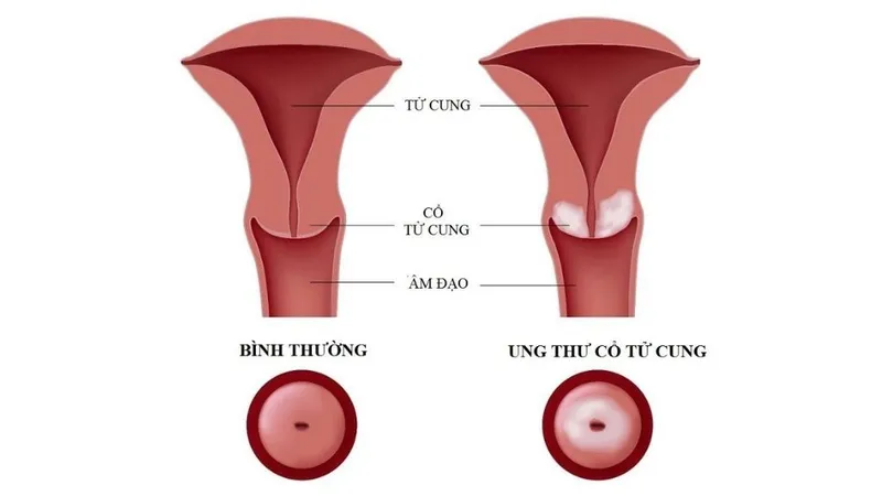 Bệnh phụ khoa: Nữ giới tuyệt đối không thể chủ quan