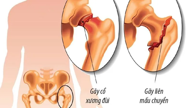 Bệnh phù tủy xương dưới sụn: Nguyên nhân và cách điều trị