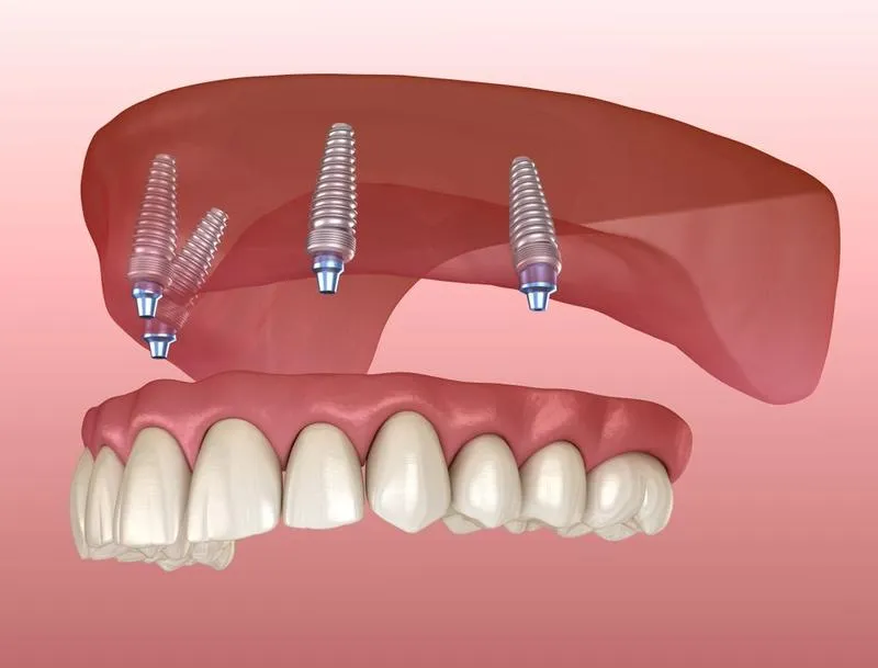 Bị mất răng toàn hàm phải làm thế nào để khắc phục?