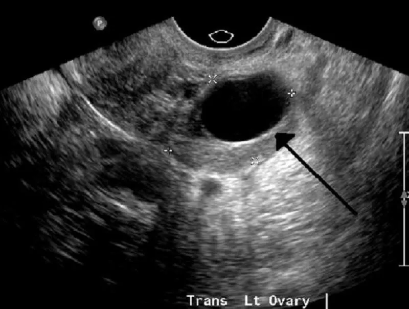 Bị u nang buồng trứng siêu âm có phát hiện ra không?