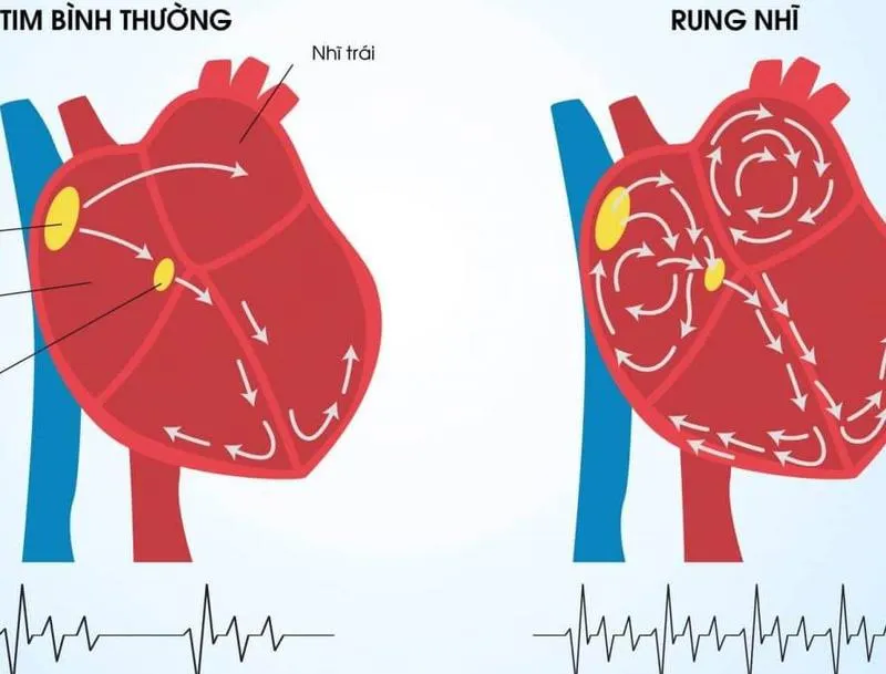 Các nguyên nhân hồi hộp do bệnh về tim không phải ai cũng biết