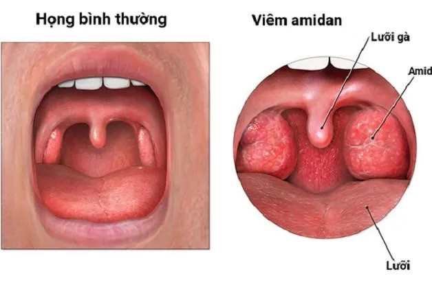 Cách chữa viêm amidan cho trẻ tại nhà