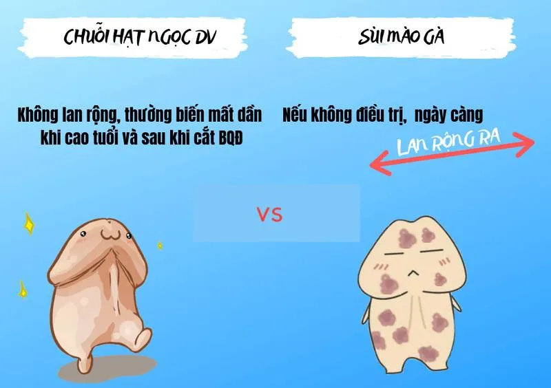 Cách phân biệt chuỗi hạt ngọc và sùi mào gà