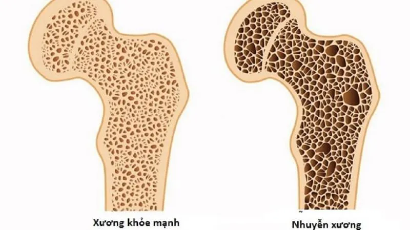 Cách phân biệt nhuyễn xương và loãng xương