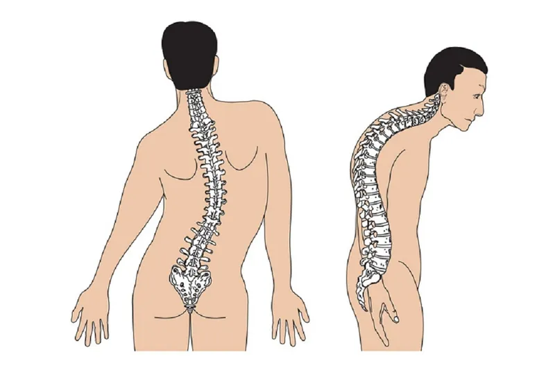 Cách phân biệt nhuyễn xương và loãng xương