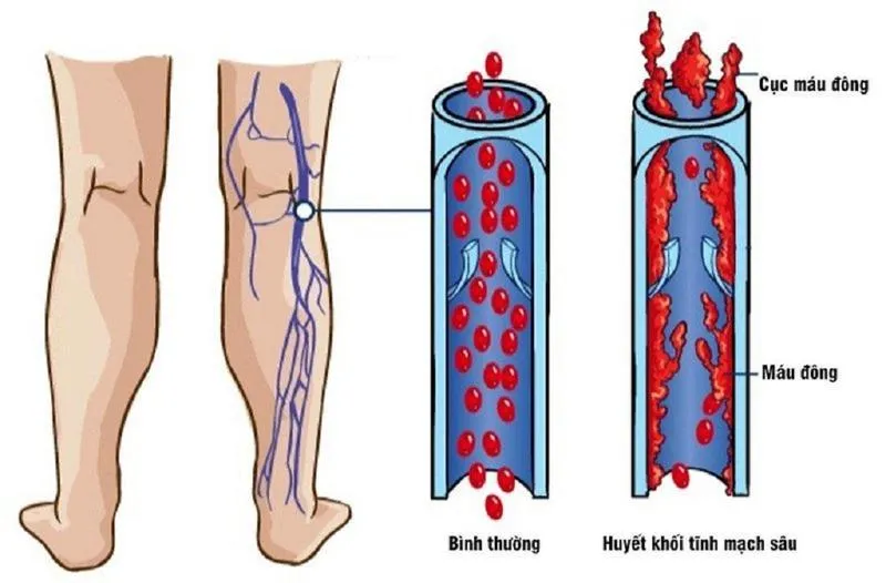 Cảnh báo hiện tượng bong nhau non 3 tháng đầu cho mẹ bầu!