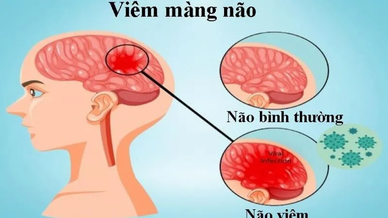 Chọc dò tủy sống có đau không, có ảnh hưởng gì không?