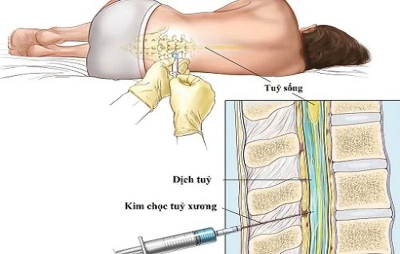 Chọc dò tuỷ sống là gì và những điều cần biết