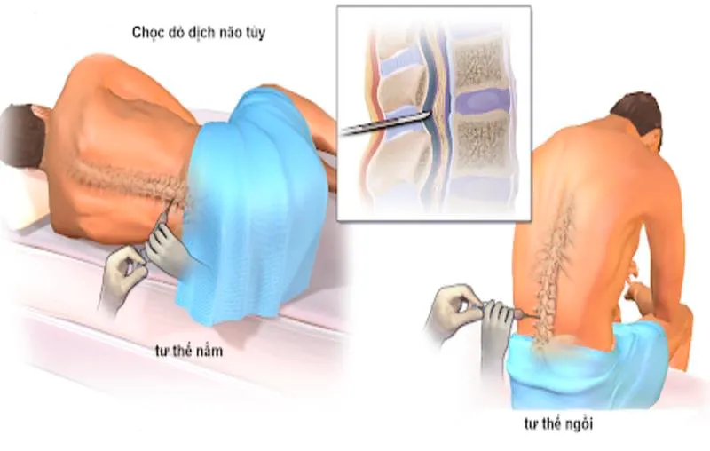 Chọc dò tuỷ sống là gì và những điều cần biết