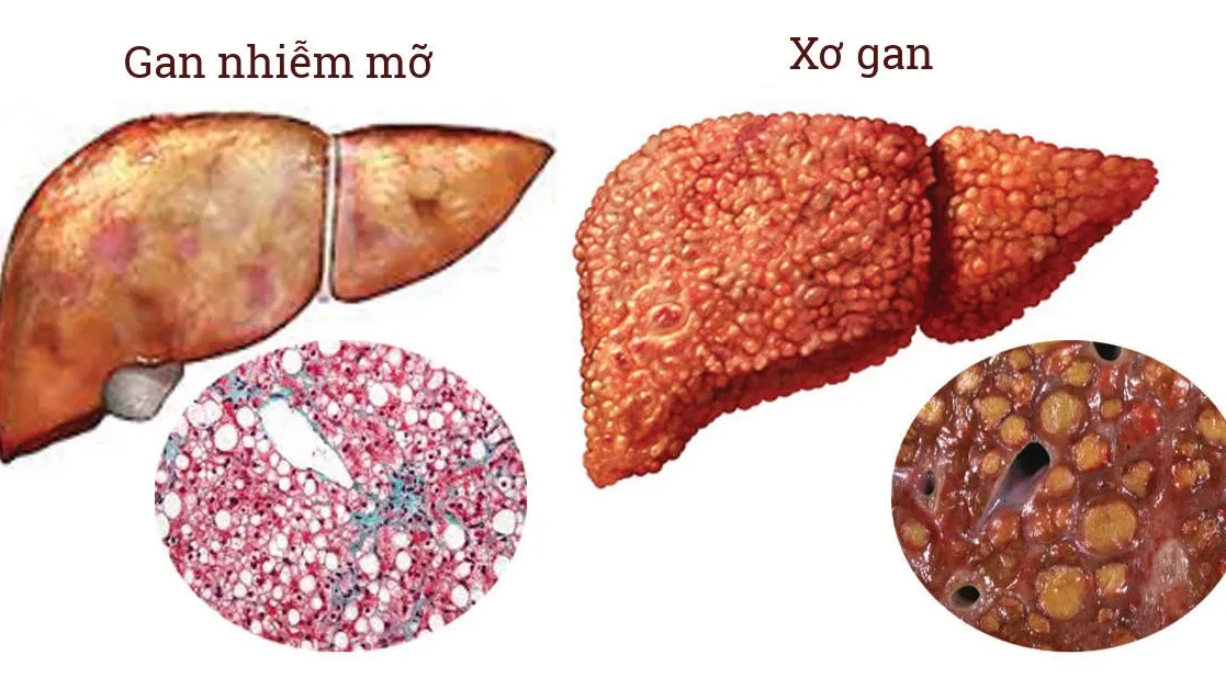 Chụp cộng hưởng từ gan và những điều cần biết