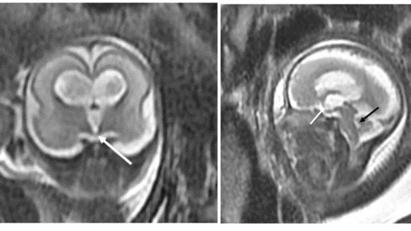 Chụp MRI não cho thai nhi: Tầm quan trọng và quy trình