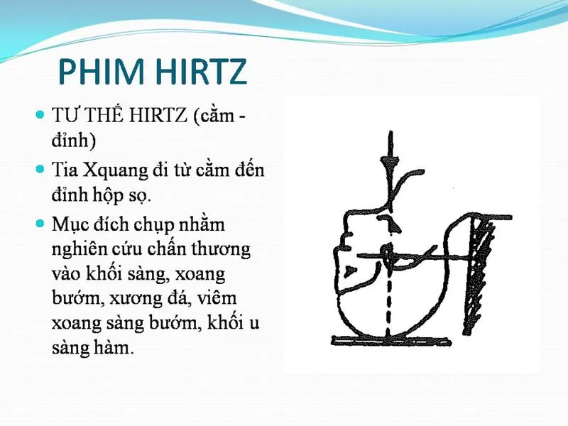 Chụp X quang xoang và những thông tin quan trọng cần biết