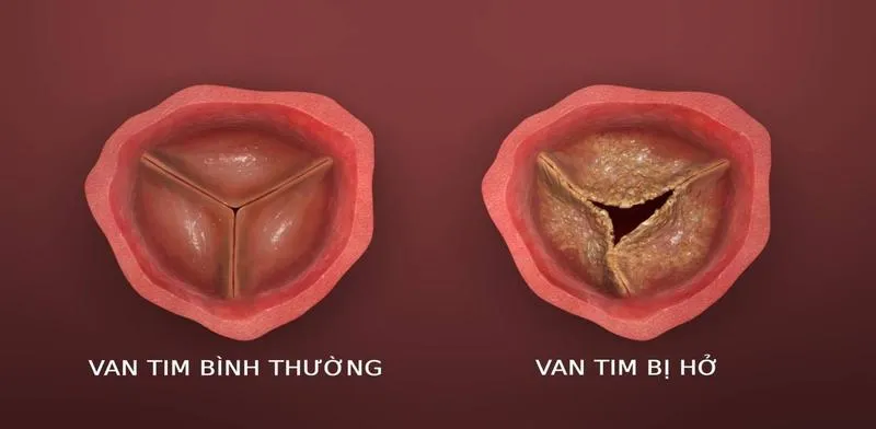 Có thật sự cây sài đất chữa hở van tim được không?