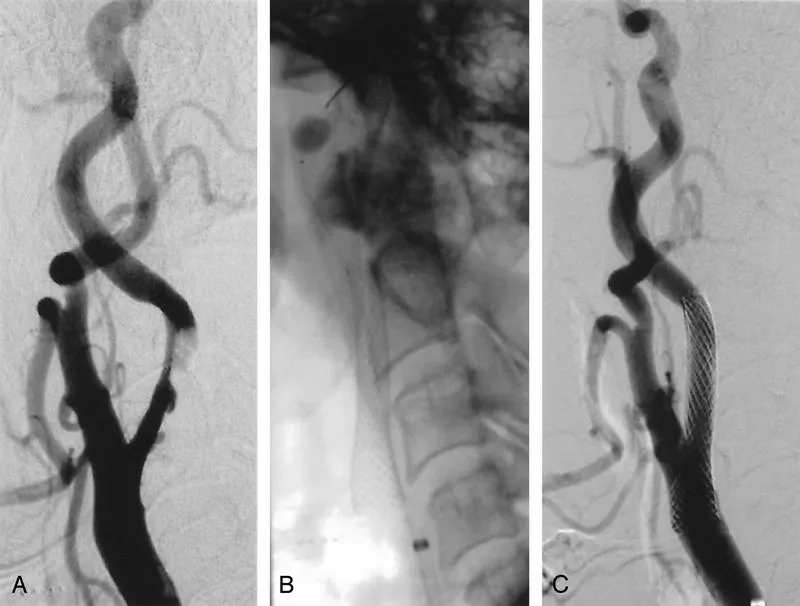 Đặt stent động mạch cảnh là gì? Khi nào cần đặt stent động mạch cảnh?