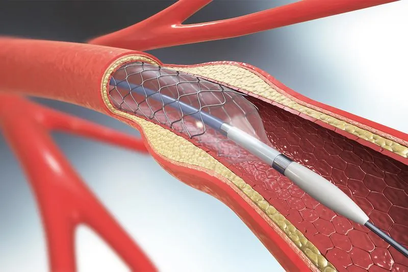 Đặt stent động mạch cảnh là gì? Khi nào cần đặt stent động mạch cảnh?