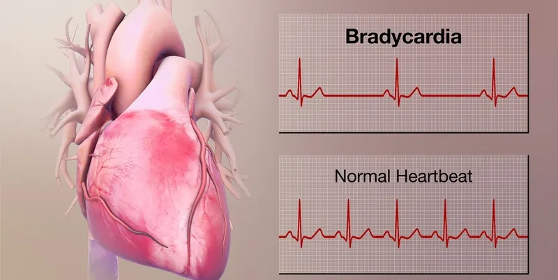 ECG thiếu máu cơ tim: Phương pháp chẩn đoán để điều trị bệnh hiệu quả