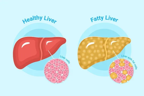 Gan nhiễm mỡ độ 2 là gì? Bị gan nhiễm mỡ độ 2 uống thuốc gì?