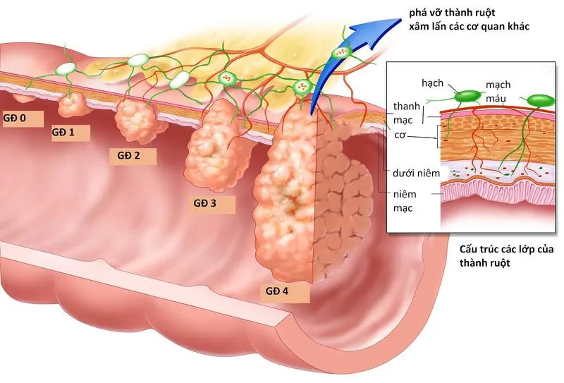 Giải đáp: Khối u đại tràng có nguy hiểm không?