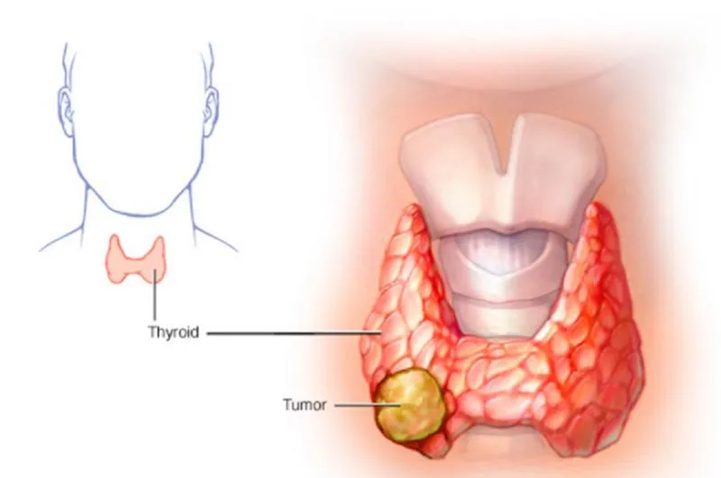 Giải đáp: Mổ bướu cổ nằm viện bao lâu?