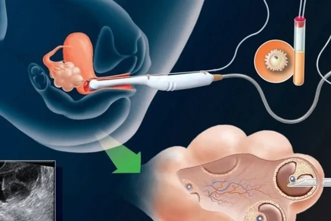 Giải đáp thắc mắc: Sau chọc hút trứng bao lâu thì có kinh?