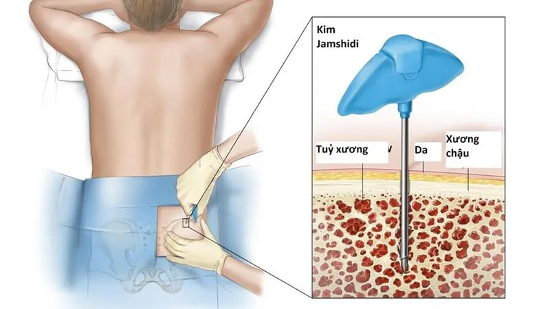 Giải đáp y khoa: Sinh thiết phát hiện những loại ung thư nào?