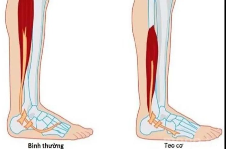 Góc giải đáp: Tại sao lại bị teo cơ chân sau bó bột?