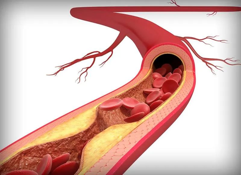 Góc giải đáp: Tại sao việc tầm soát xơ vữa mạch máu rất quan trọng?