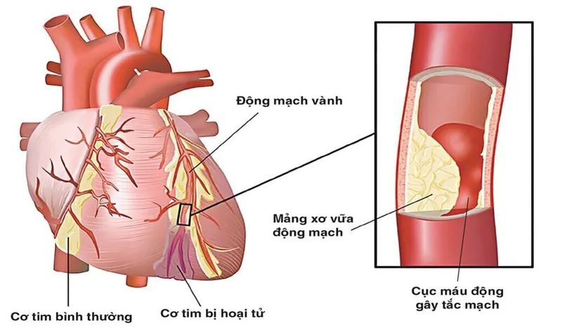 Góc giải đáp: Tại sao việc tầm soát xơ vữa mạch máu rất quan trọng?