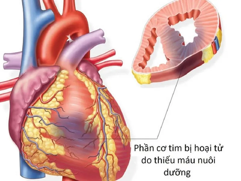 Góc giải đáp thắc mắc: Bệnh nhồi máu cơ tim có nguy hiểm không?