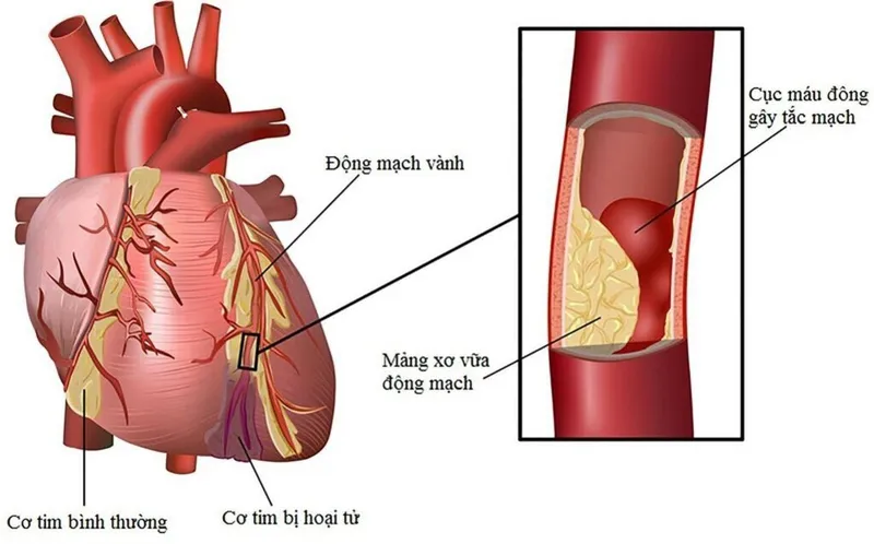 Góc giải đáp thắc mắc: Bệnh nhồi máu cơ tim có nguy hiểm không?