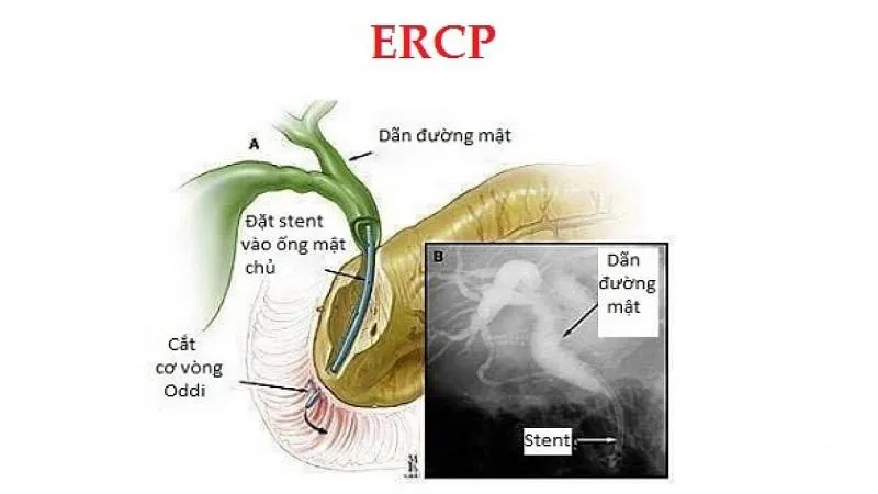 Hẹp bóng Vater: Nguyên nhân, chẩn đoán và điều trị