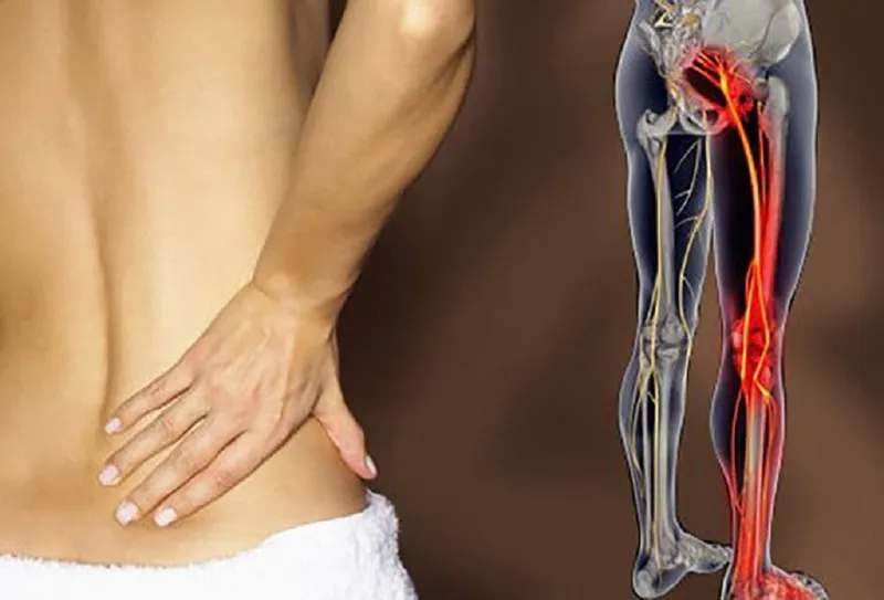 Hội chứng Piriformis: Nguyên nhân, dấu hiệu nhận biết và cách điều trị