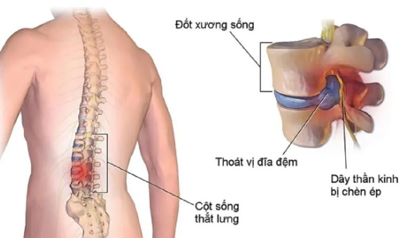 Hội chứng rễ thần kinh tủy sống: Nguyên nhân, dấu hiệu và phương pháp điều trị