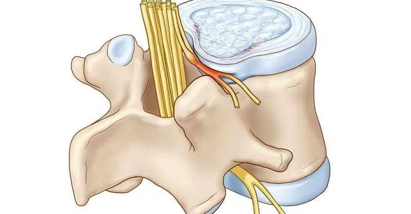 Hội chứng rễ thần kinh tủy sống: Nguyên nhân, dấu hiệu và phương pháp điều trị