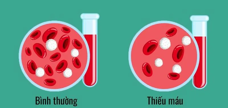 Huyết sắc tố là gì? Các nguyên nhân gây tình trạng huyết sắc tố thấp