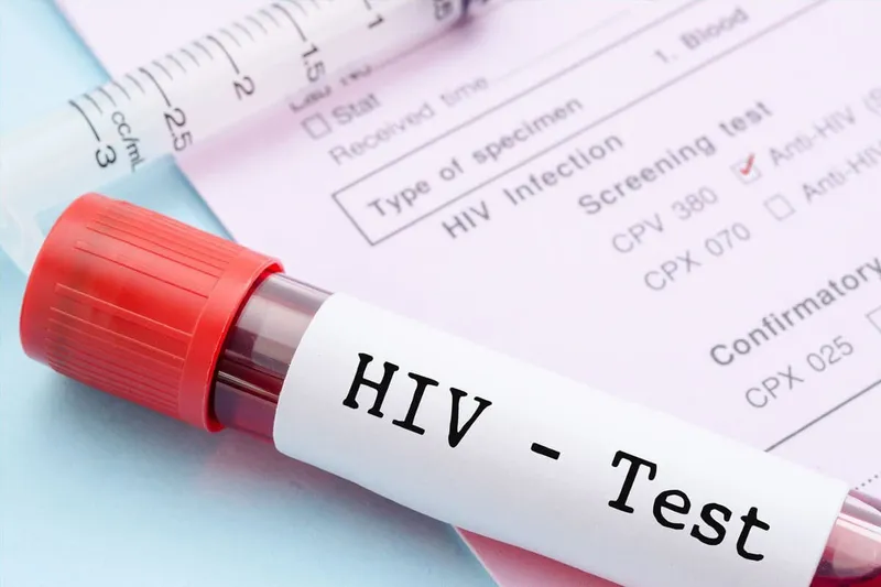 Kết quả xét nghiệm HIV bao gồm những loại nào?