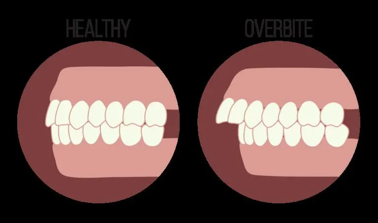 Khắc phục tình trạng hô hàm và hô răng một cách hiệu quả