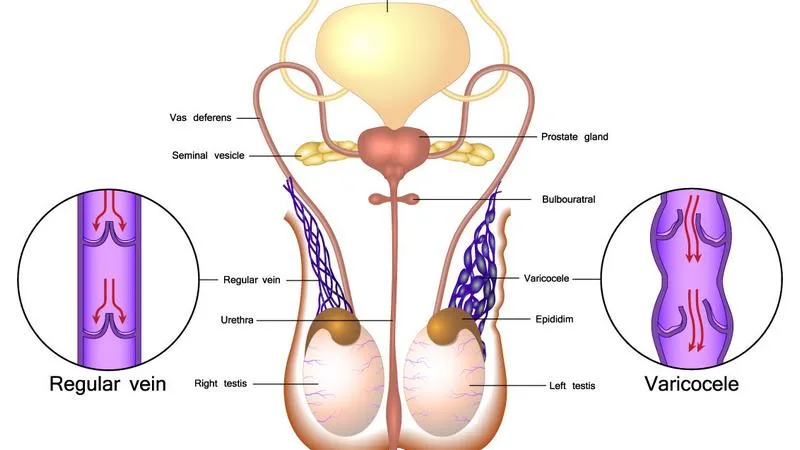 Khi nào cần điều trị giãn tĩnh mạch thừng tinh độ 1? Bệnh được điều trị như thế nào?