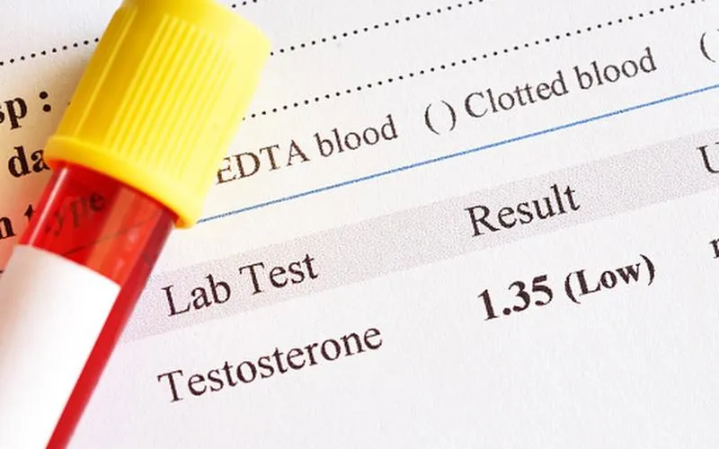 Khi nào cần thực hiện xét nghiệm testosterone?