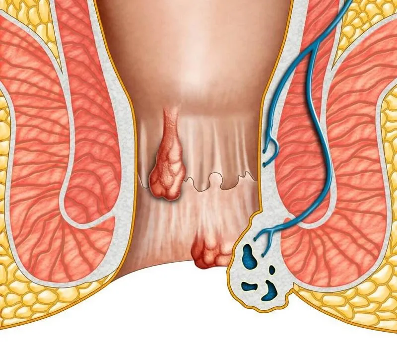 Lòi dom là gì? Mách bạn những cách chữa lòi dom tại nhà đơn giản, hiệu quả