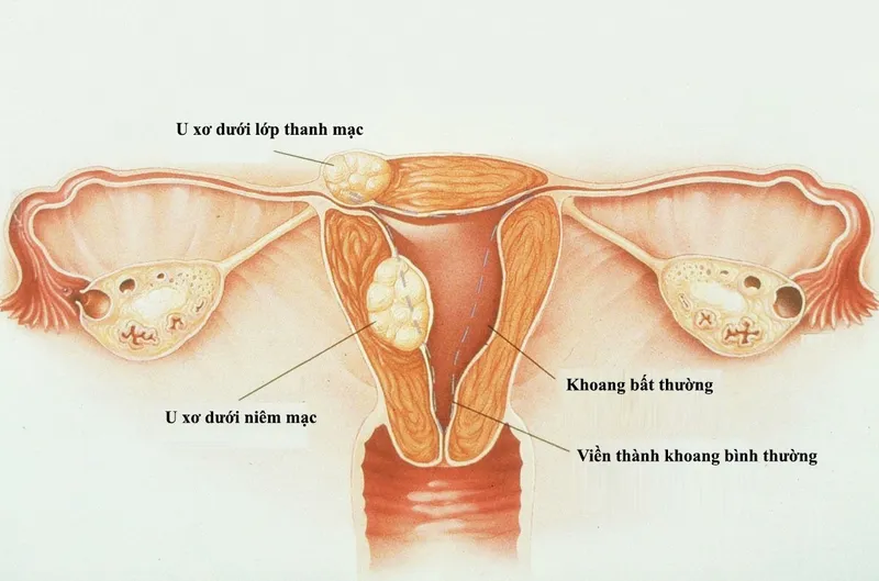 Một số bệnh phụ khoa thường gặp và cách chăm sóc sức khỏe phụ khoa để phòng bệnh