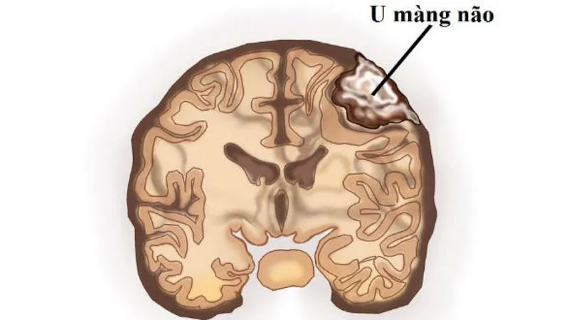 Một số thông tin về mổ nội soi u màng não và cách chăm sóc sau phẫu thuật