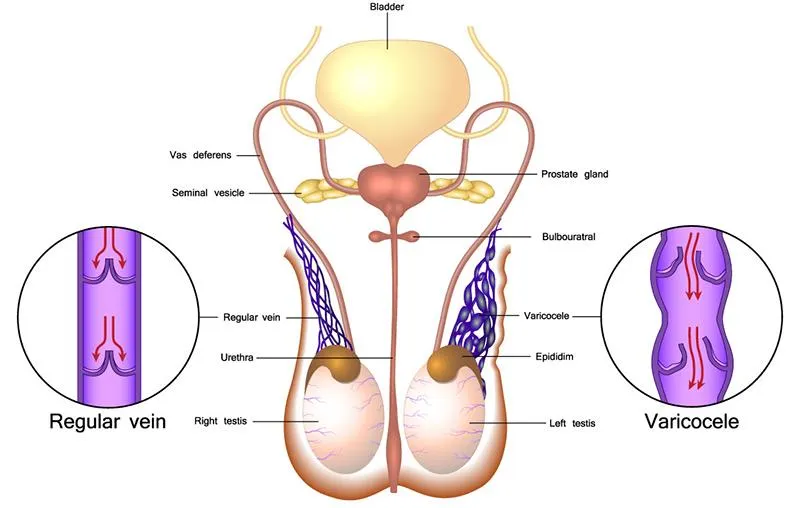 Một vài phương pháp mà bạn có thể áp dụng để tự chữa giãn tĩnh mạch thừng tinh tại nhà