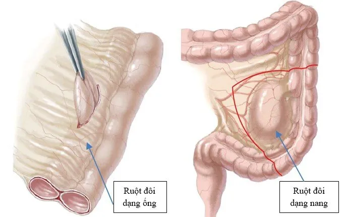 Nang ruột đôi là bệnh gì? Có gây nguy hiểm hay không?