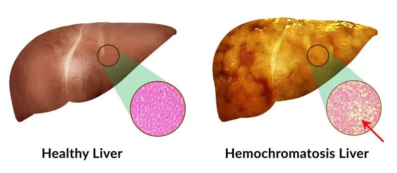 Nguyên nhân gây bệnh alpha Thalassemia và cách phòng ngừa hiệu quả